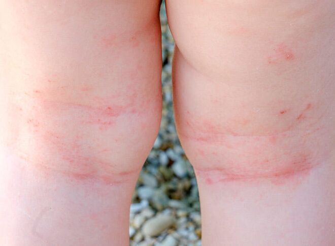 Dry Skin Patches On Baby Legs And Arms Atopic Dermatitis Symptoms