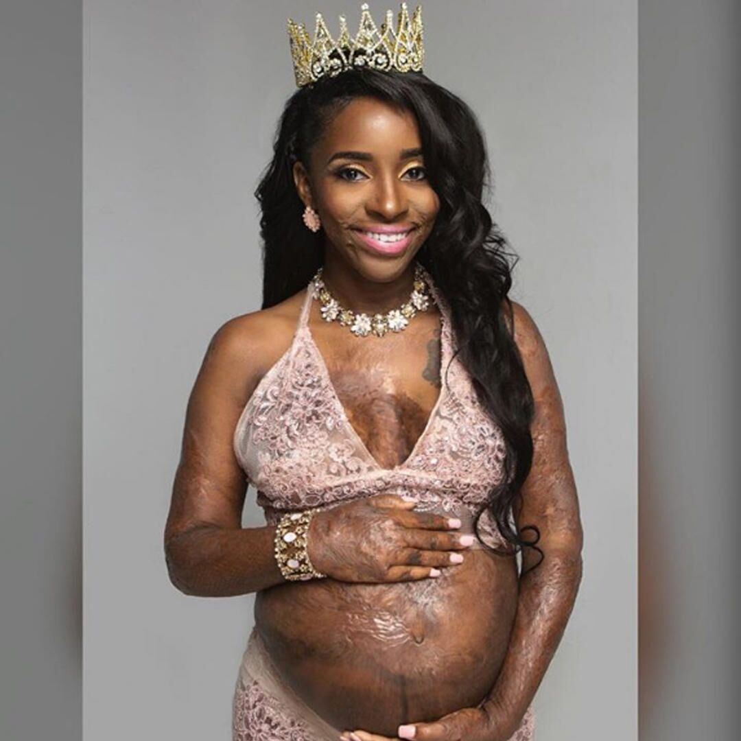 Burn Victim Shares Inspiring Maternity Photo Shoot